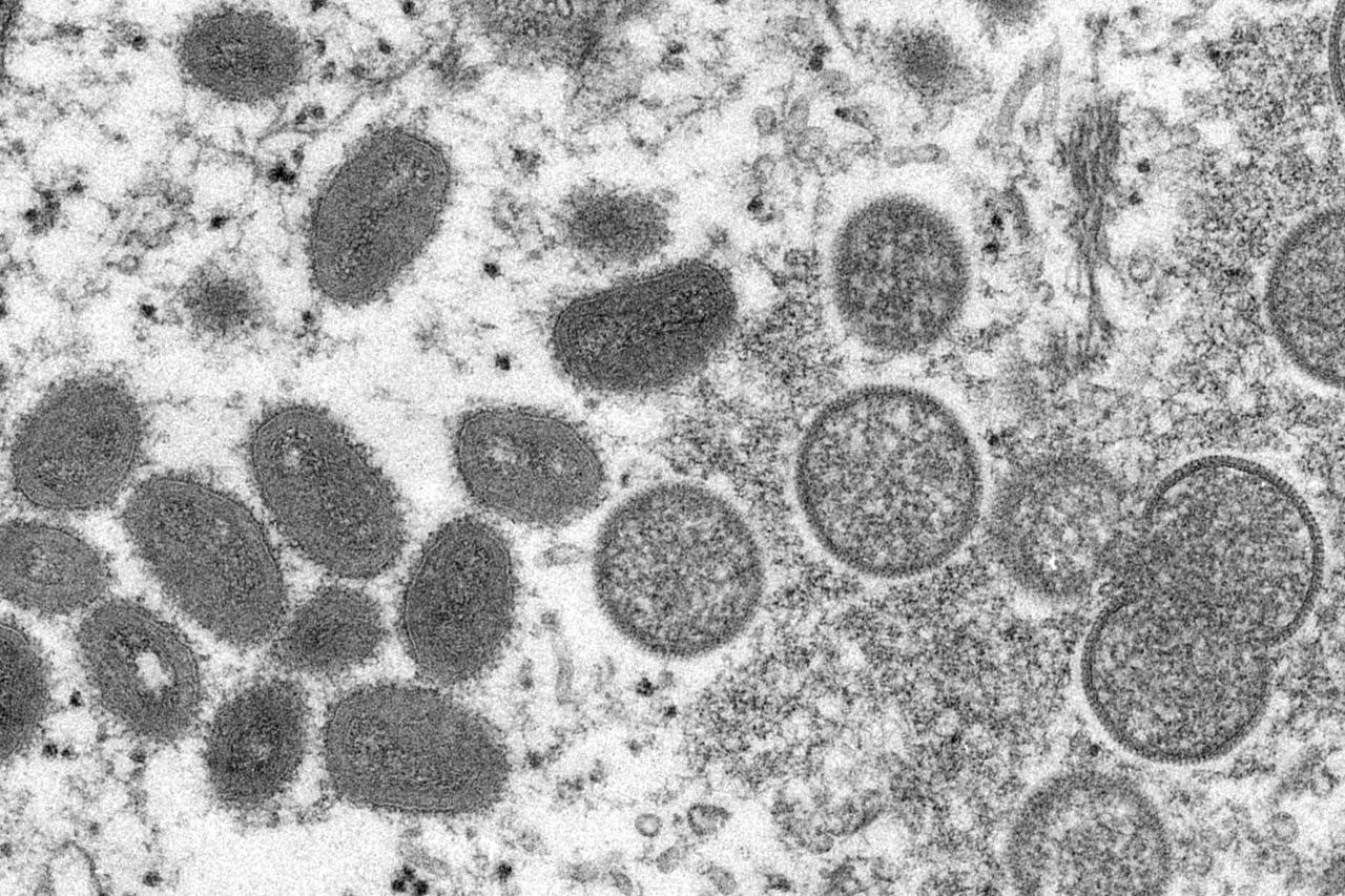 Il n’y a eu aucun cas ou suspicion de variole en Slovaquie |  .une semaine